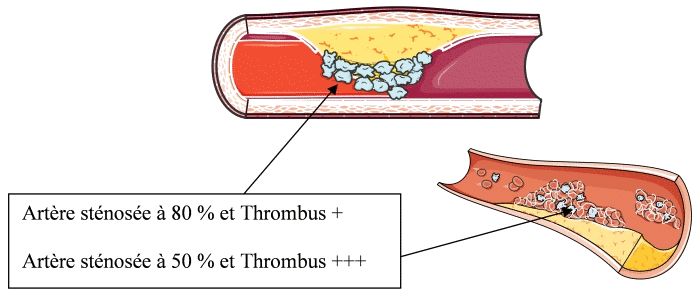 Athérome et thrombose