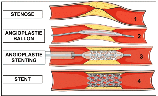 Angioplastie - stent