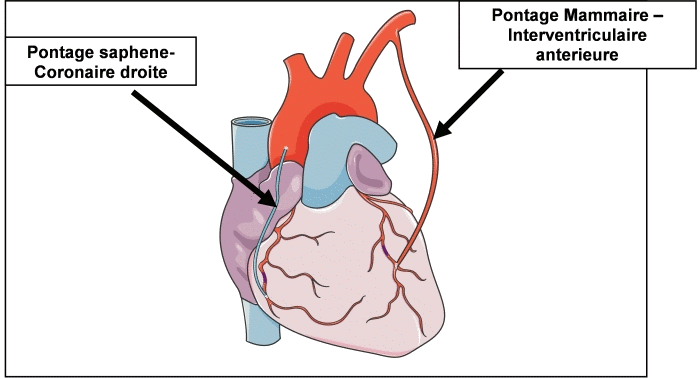 Pontages coronariens
